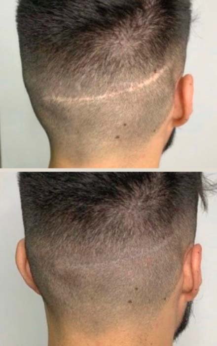 Camuflaje con micropigmentación de cicatrices. Técnica FUT