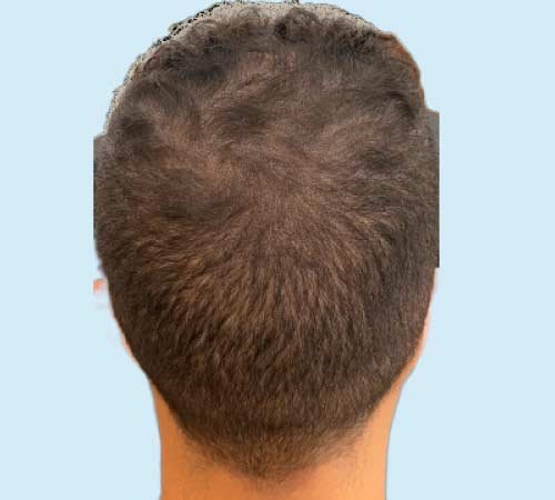 Capilar con mas densidad con micropigmentacion caso 4 DESPUES