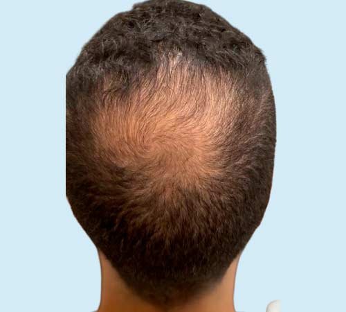Capilar con mas densidad con micropigmentacion caso 4 antes
