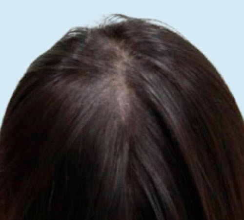 Caso 6 micropigmentacion capilar para mujer despues del tratamiento