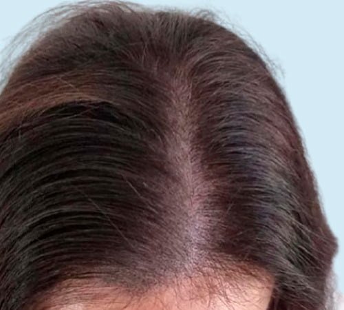 Caso 8 para micro en mujeres antes del tratamiento