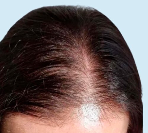 Caso 8 para micro en mujeres despues del tratamiento