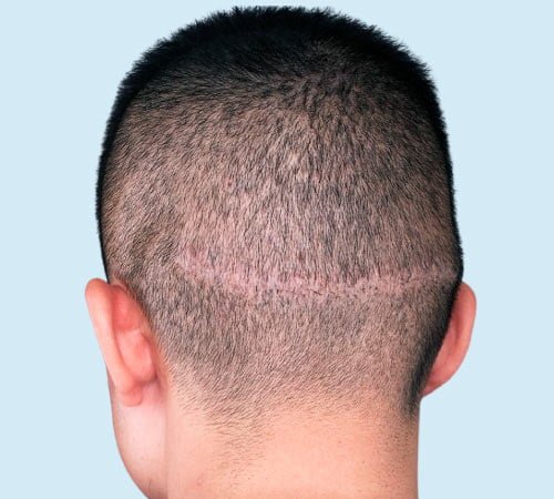 Cicatriz FUE mejorada con tecnica de micropigmentacion antes de la sesion