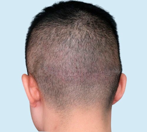 Cicatriz FUE mejorada con tecnica de micropigmentacion despues de la sesion