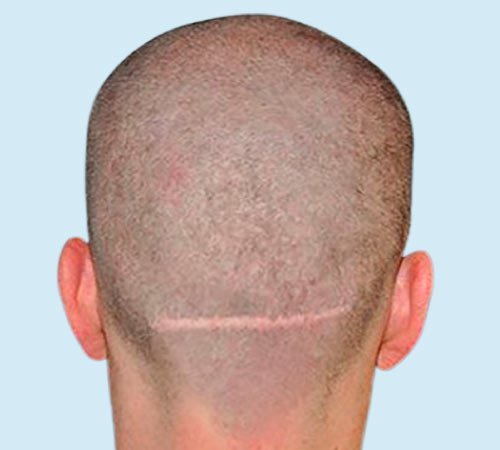 Cicatriz FUT camuflada con micro antes del tratamiento