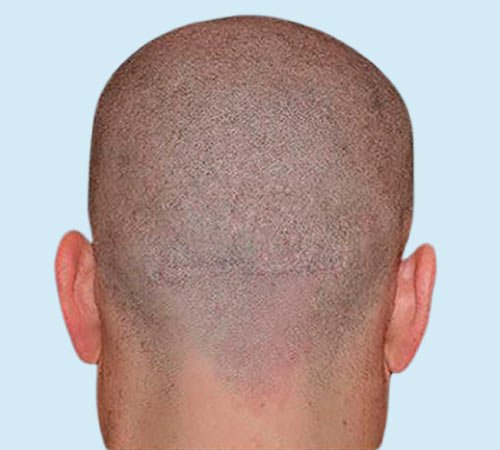 Cicatriz FUT camuflada con micro despues del tratamiento