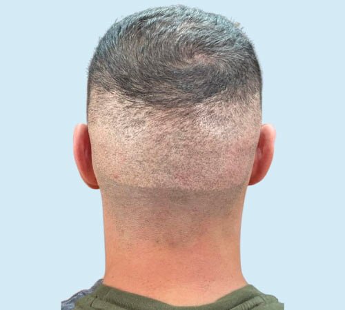 Como camuflar cicatrices FUE con micro 1