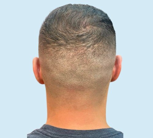 Como camuflar cicatrices FUE con micro despues del tratamiento