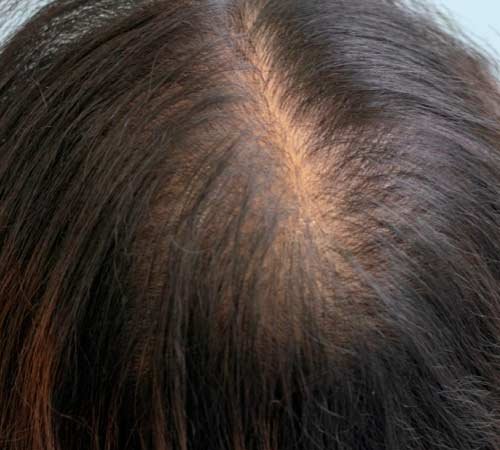 Densidad capilar en mujeres caso 3 antes del tratamioento con micro