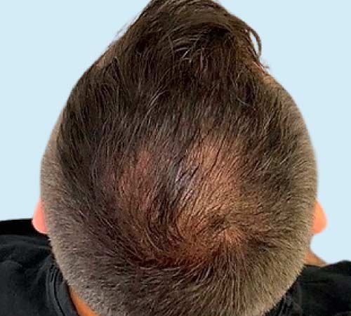 Efecto densidad en la micropigmentacion caso 2 antes