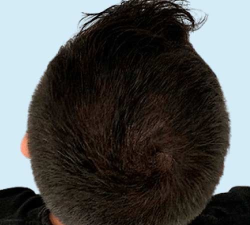 Efecto densidad en la micropigmentacion caso 2 despues del tratamiento