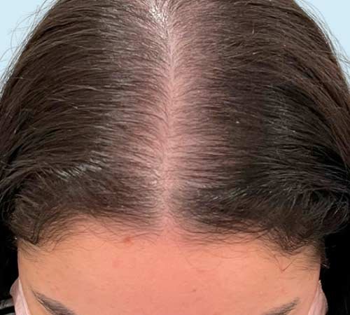 Mayor cantidad de pelo con micro capilar en mujeres caso 4 antes del tratamiento