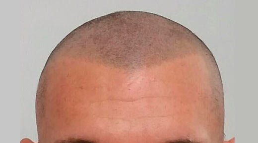 Micro capilar caso 4 despues del tratamiento