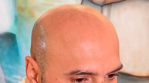 Micro capilar caso 5 antes del tratamiento