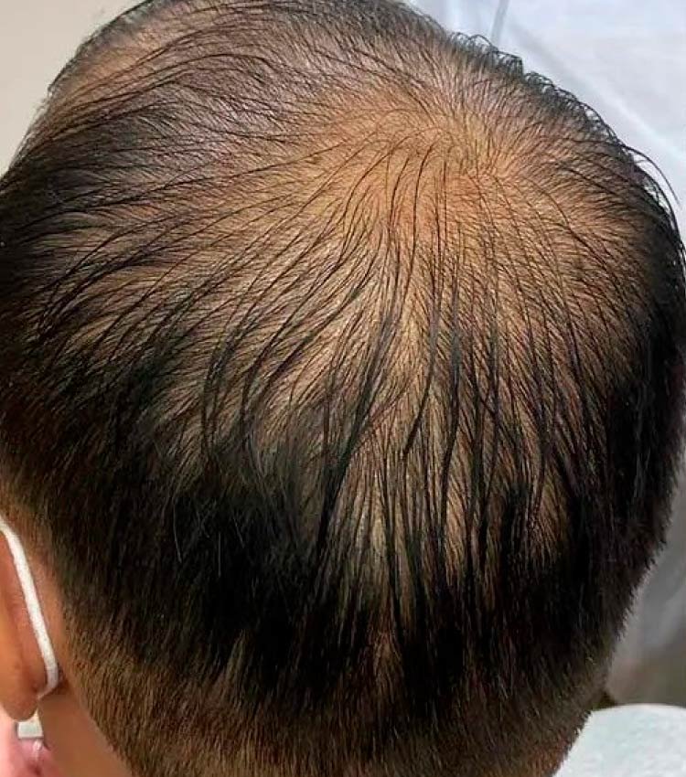 Micro capilar simulando el pelo largo caso 3 antes