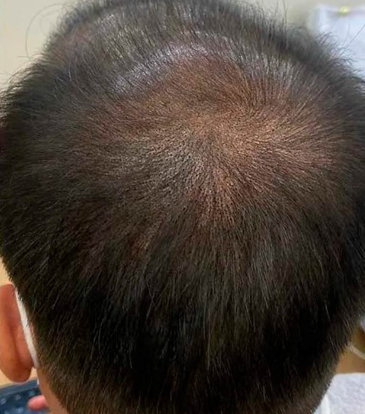 Micro capilar simulando el pelo largo caso 3 despues