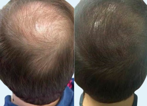 Micropigmentación con efecto densidad 1 Micropigmentación con efecto densidad capilar