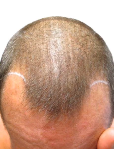 Micro con mas densidad de cabello caso 6 antes del tratamiento