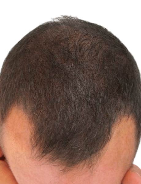 Micro con mas densidad de cabello caso 6 despues de tratamiento