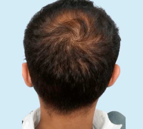 Micro pelo a pelo con efecto densidad caso 3 antes