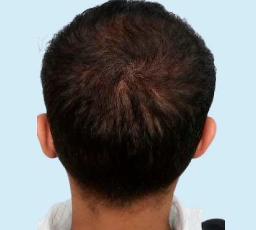 Micro pelo a pelo con efecto densidad caso 3 despues