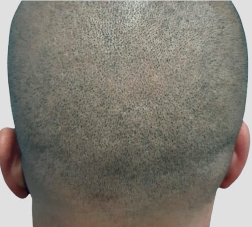 Micropigmentacion cicatrices metodo FUE DESPUES tratamiento