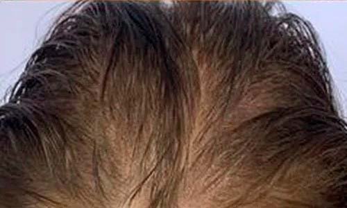 Micropigmentacion de pelo largo caso 1 despues del tratamiento