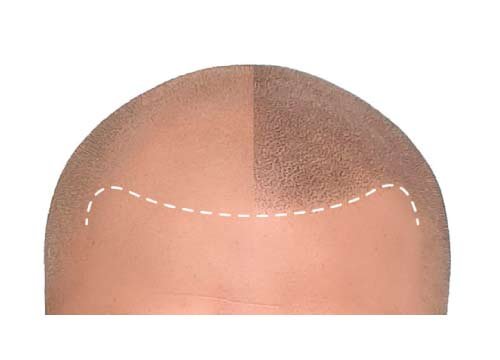 Micropigmentacion efecto rasurado ejemplo 3