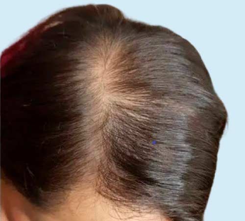 Mujer con micropigmentacion capilar caso uno antes