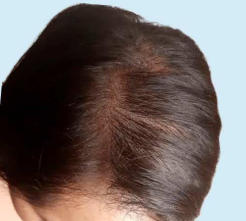 Mujer con micropigmentacion capilar caso uno despues