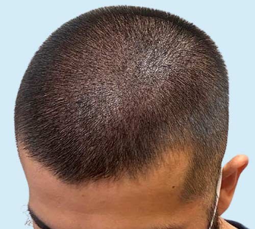 Sesion micro capilar con mas densidad caso 5 despues