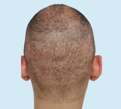 Tecnica de micropigmentacion cicatrices FUT antes del tratamiento