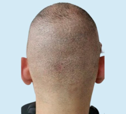 Tecnica de micropigmentacion cicatrices FUT despues del tratamiento