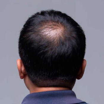 Micropigmentación con efecto densidad capilar