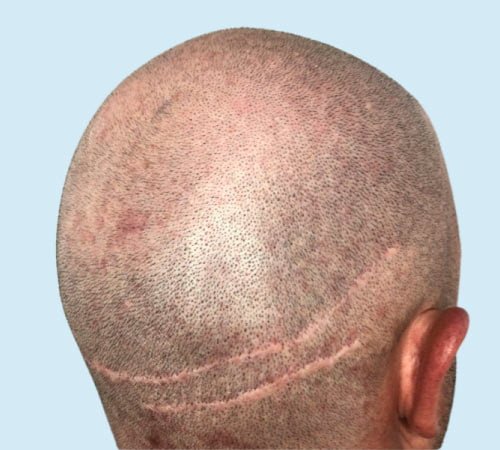 quitar cicatriz FUS con micro antes del tratamiento