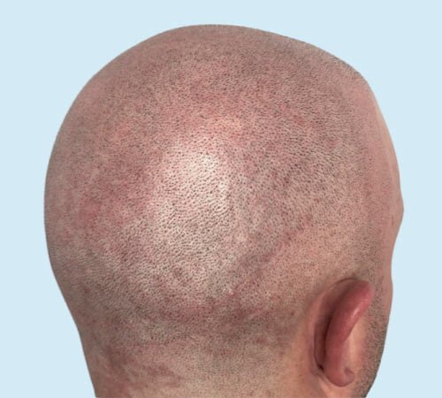 quitar cicatriz FUSS con micro despues del tratamiento
