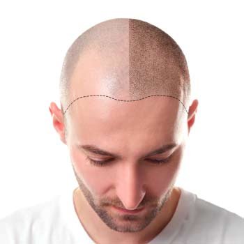 micropigmetacion capilar efecto rasurrado look moderno
