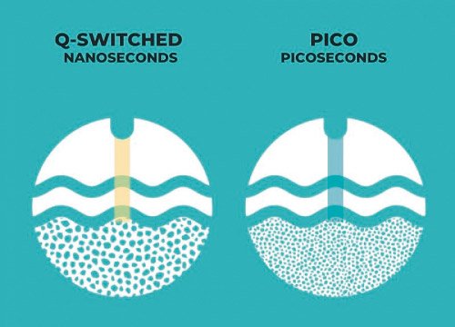 Comparativa láser de nanosegundos y láser de picosegundos