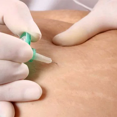 Carboxiterapia 2 Carboxiterapia corporal para mejorar las estrías