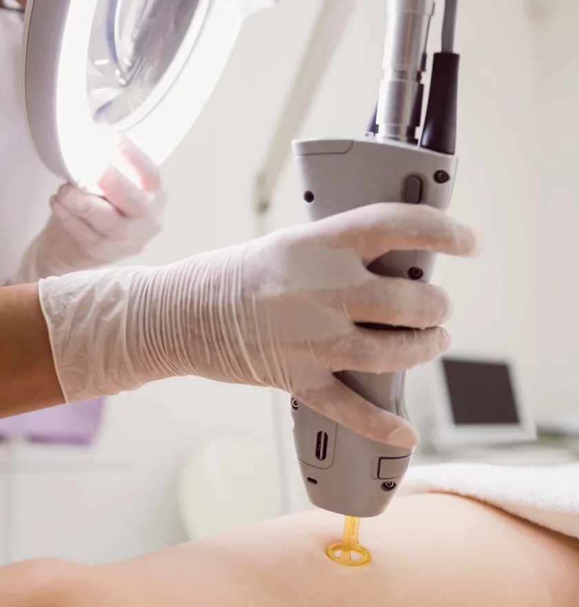 Depilación láser de axilas en Clínica Center Granada