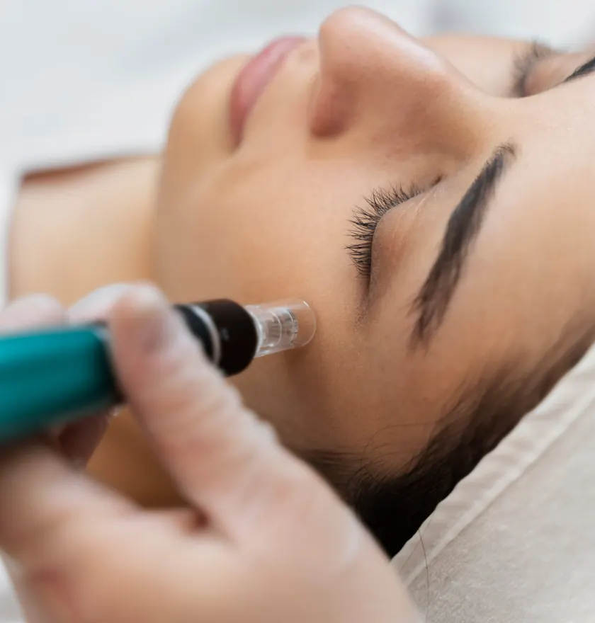 Oferta de Dermapen con exosomas en Clínica Center Granada