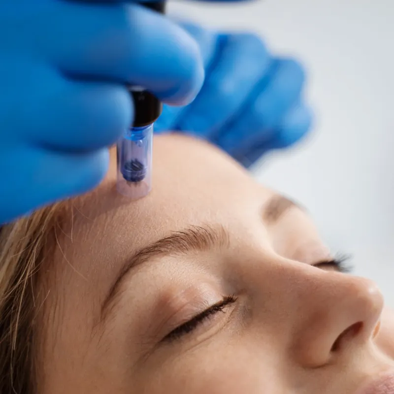 Oferta Dermapen + Exosomas 99€ 2 Sesión de Dermapen con exosomas