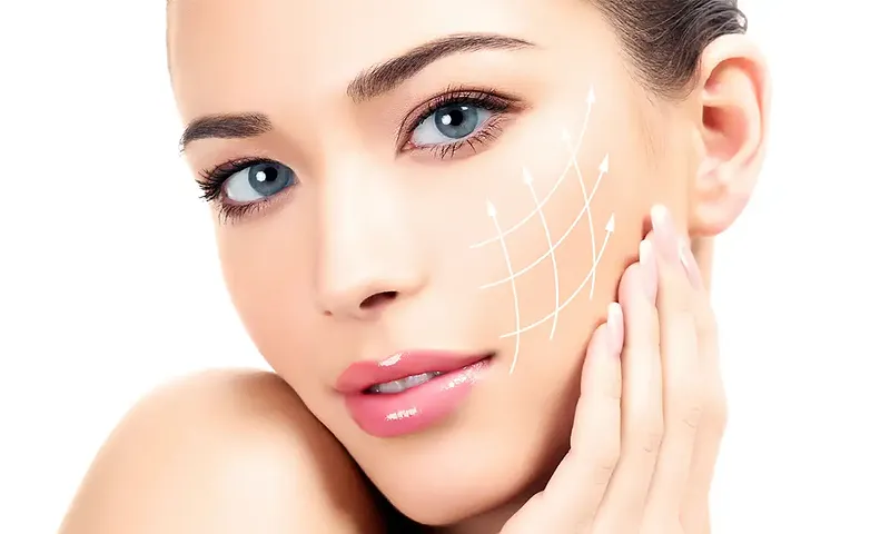 Efecto lifting con hilos tensores en el óvalo facial