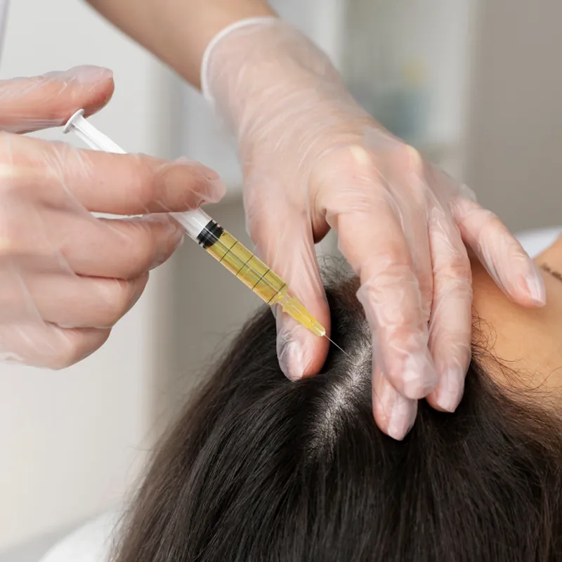 Mesoterapia capilar 2 Mesoterapia capilar en el cuero cabelludo para la caída del pelo