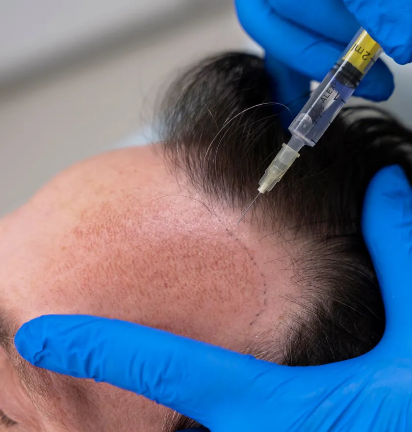Mesoterapia capilar para la caída del pelo en Clínica Center Granada