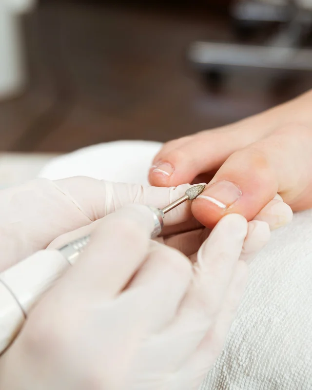 Podología 2 Fresado de uña en una sesión de quiropodia en Clínica Center Granada