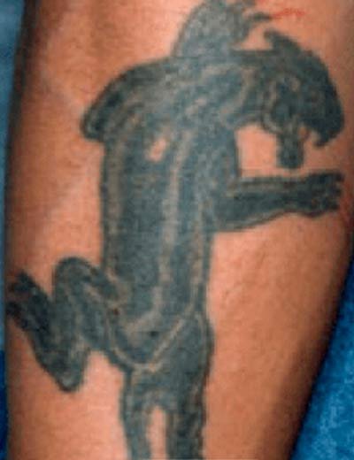 Eliminación de tatuaje con láser en Granada, caso 1: antes