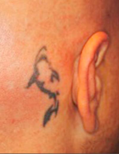 Eliminación de tatuaje con láser en Granada, caso 10: antes