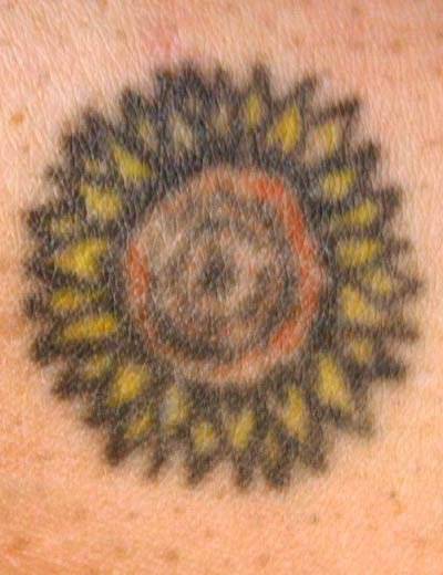 Eliminación de tatuaje con láser en Granada, caso 11: antes