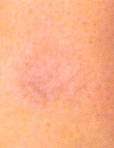 Eliminación de tatuaje con láser en Granada, caso 11: después